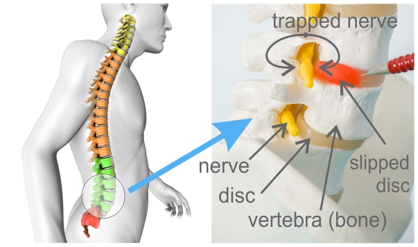 Trapped Nerve Treatment In Wimbledon Raynes Park Morden 