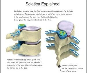 Sciatica Explained